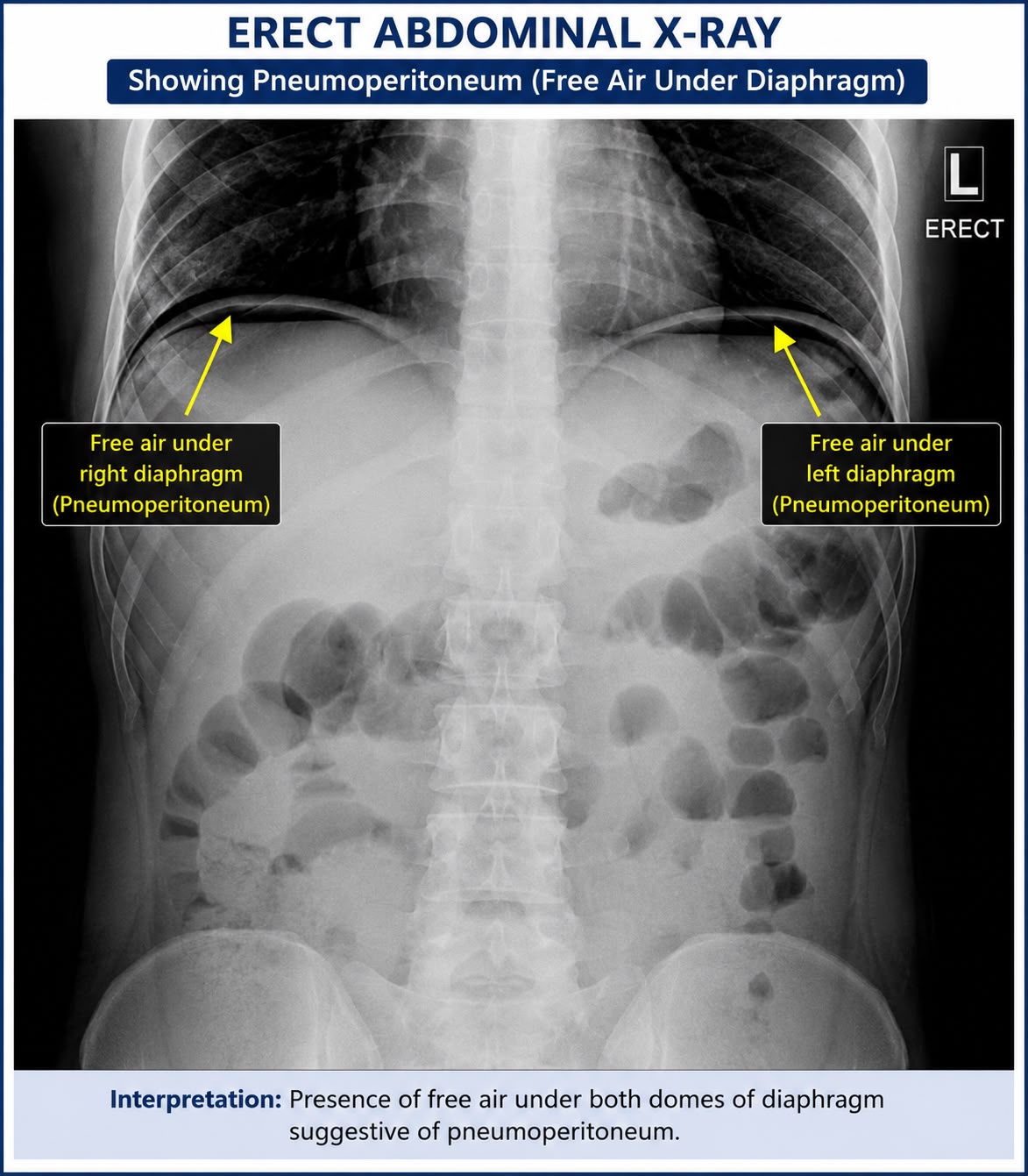 Erect abdominal X-ray showing pneumoperitoneum