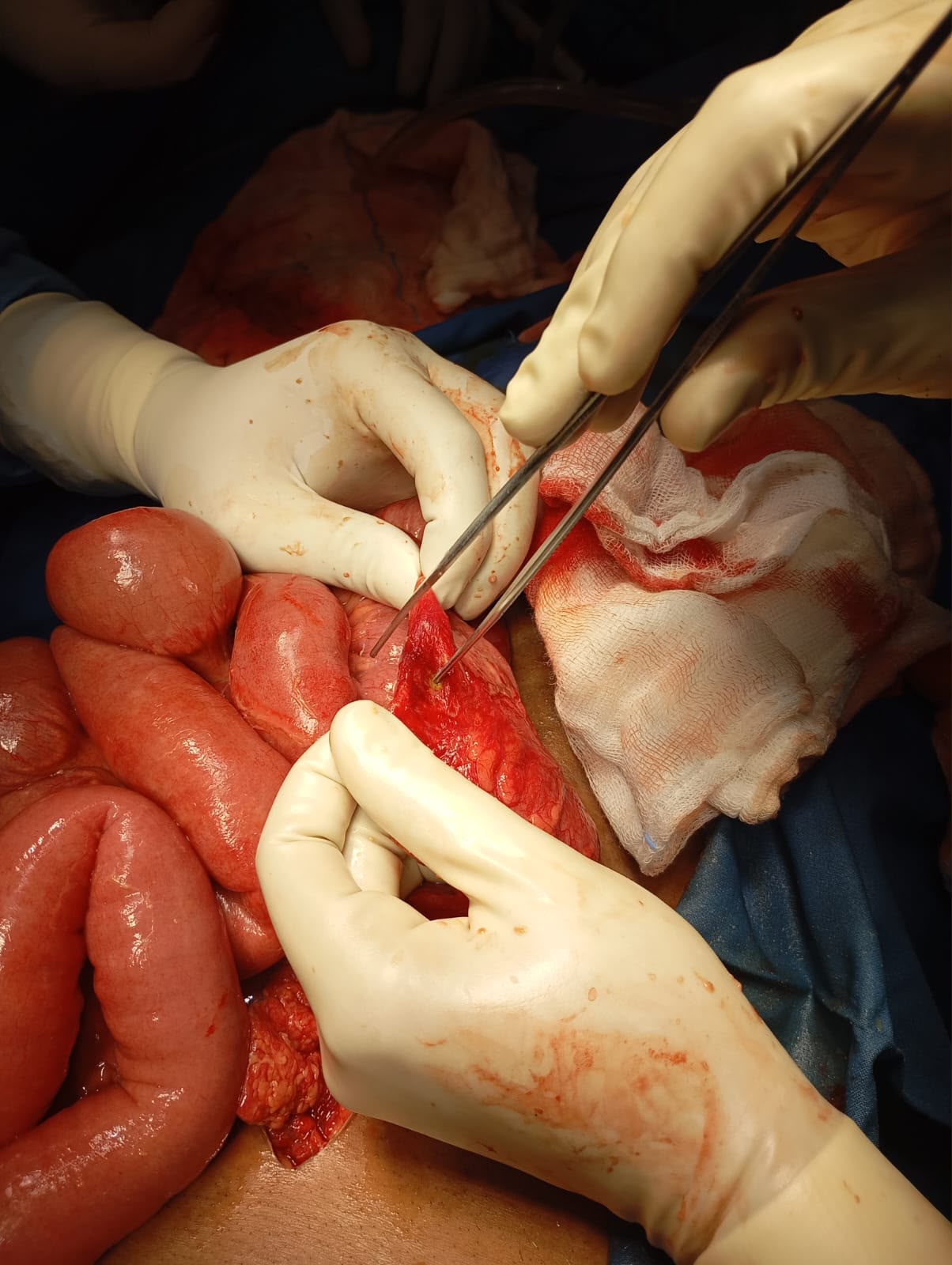 CT abdomen demonstrating pneumoperitoneum