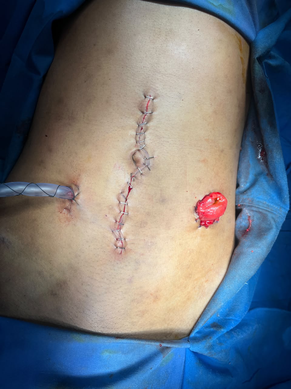 Intraoperative image showing cecal perforation